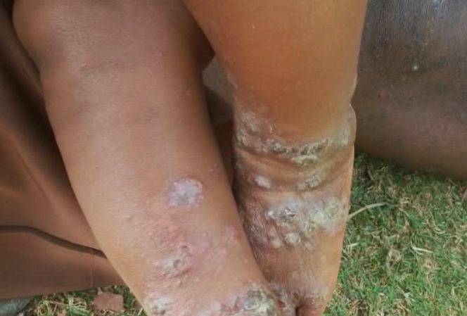 
					Wabah penyakit infeksi kulit di Distrik Mewoluk Puncak Jaya. (Foto dok: IST)