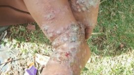 Wabah penyakit infeksi kulit di Distrik Mewoluk Puncak Jaya. Foto: ist