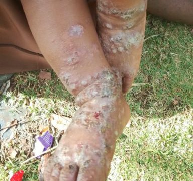 Wabah penyakit infeksi kulit di Distrik Mewoluk Puncak Jaya. Foto: ist